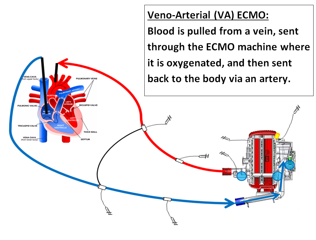 ECMO Le Bonheur Children's Hospital